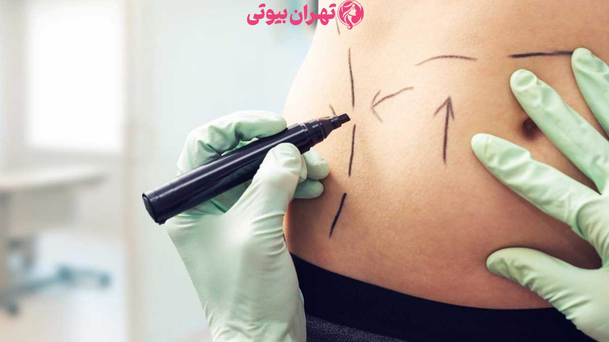 10 بهترین جراح لیپوماتیک در تهران