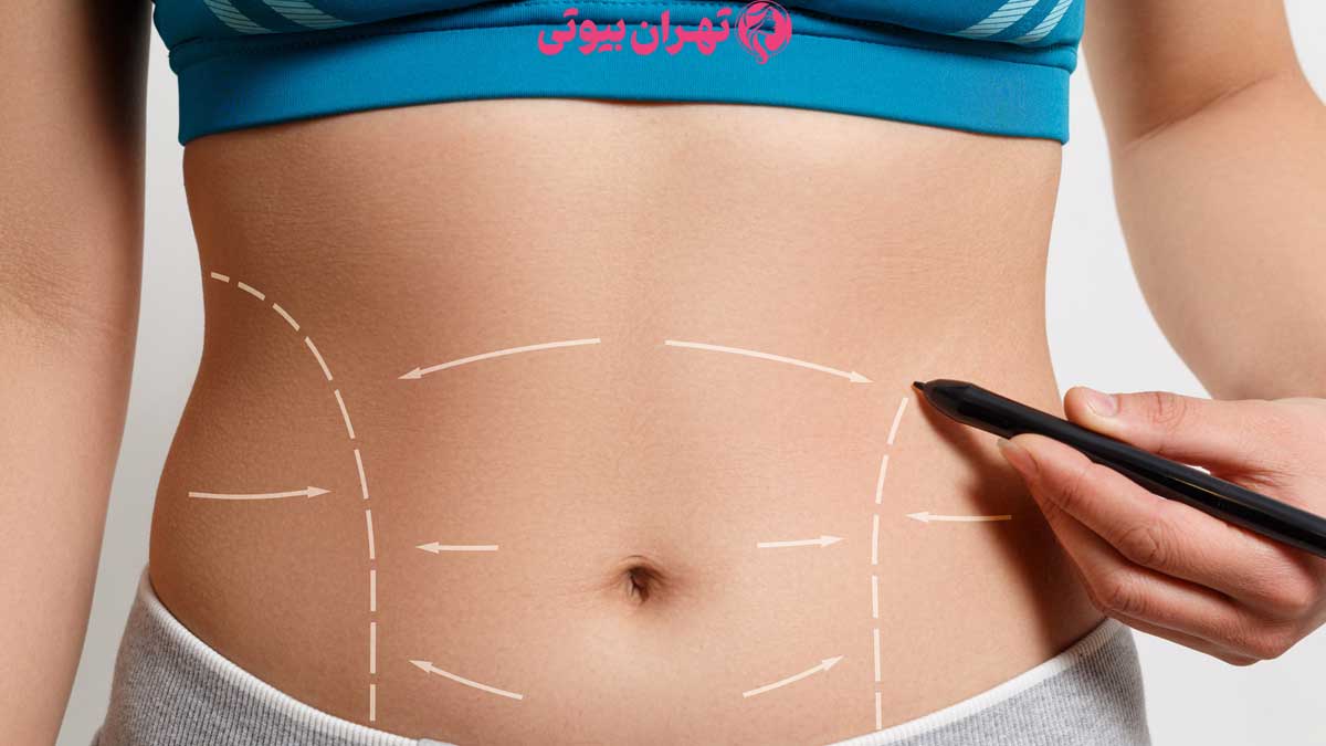 10 بهترین جراح لیپوماتیک در تهران