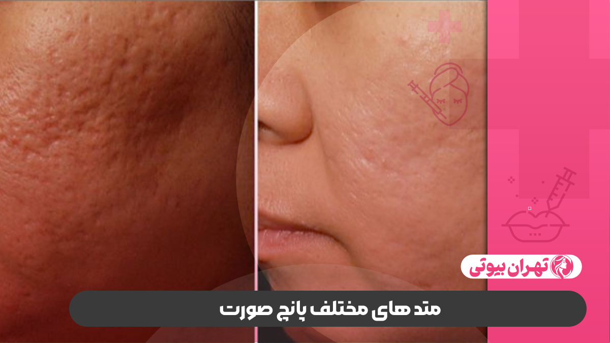 10 بهترین مرکز پانچ صورت در تهران