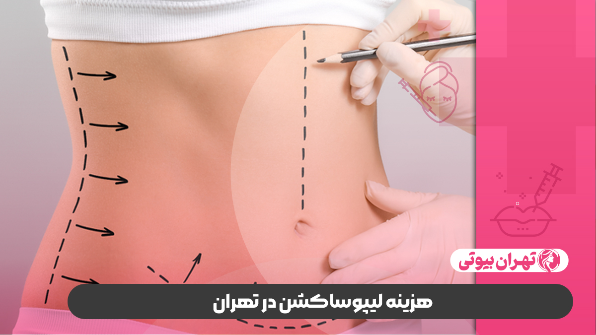 10 بهترین جراح لیپوساکشن در تهران