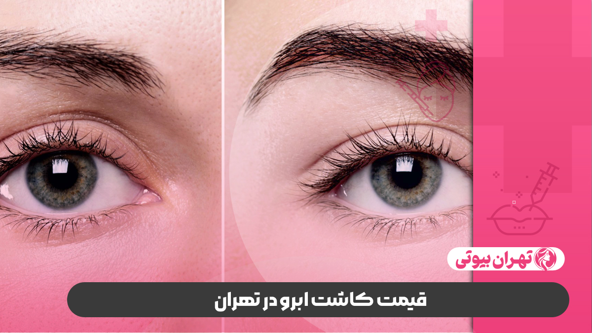 10 بهترین کلینیک کاشت ابرو در تهران