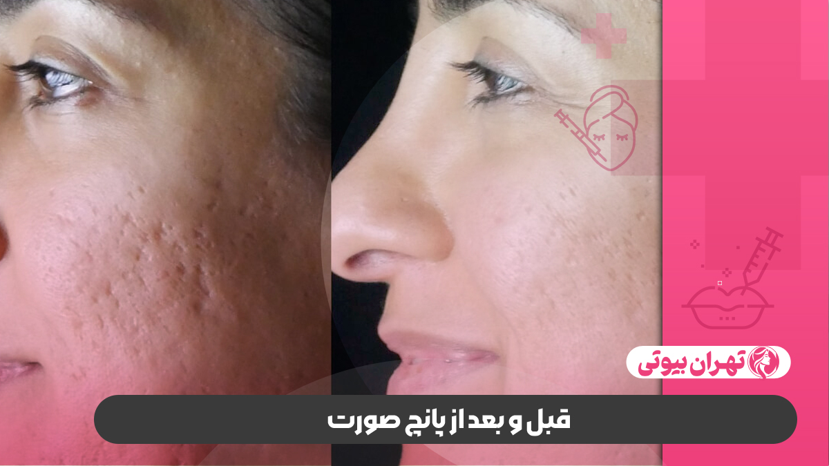 10 بهترین مرکز پانچ صورت در تهران