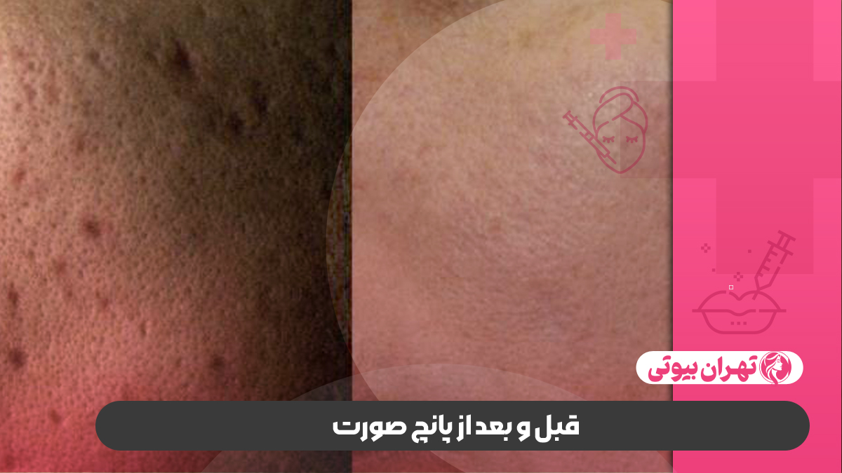 10 بهترین مرکز پانچ صورت در تهران