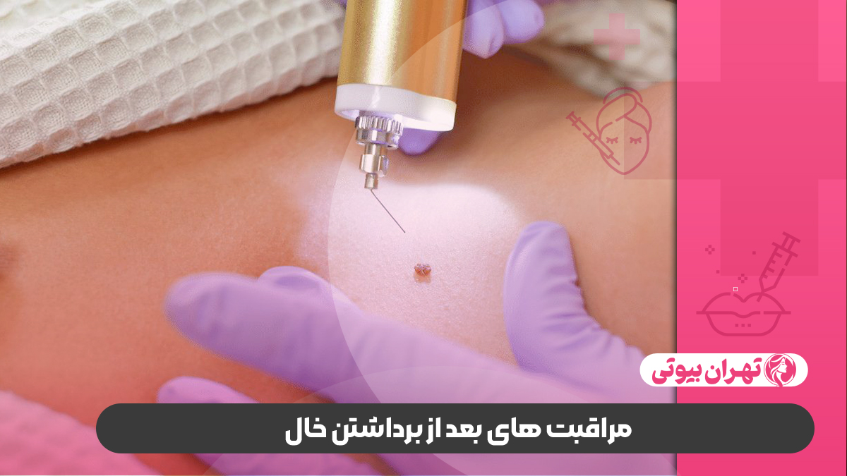 10 بهترین دکتر برداشتن خال در تهران