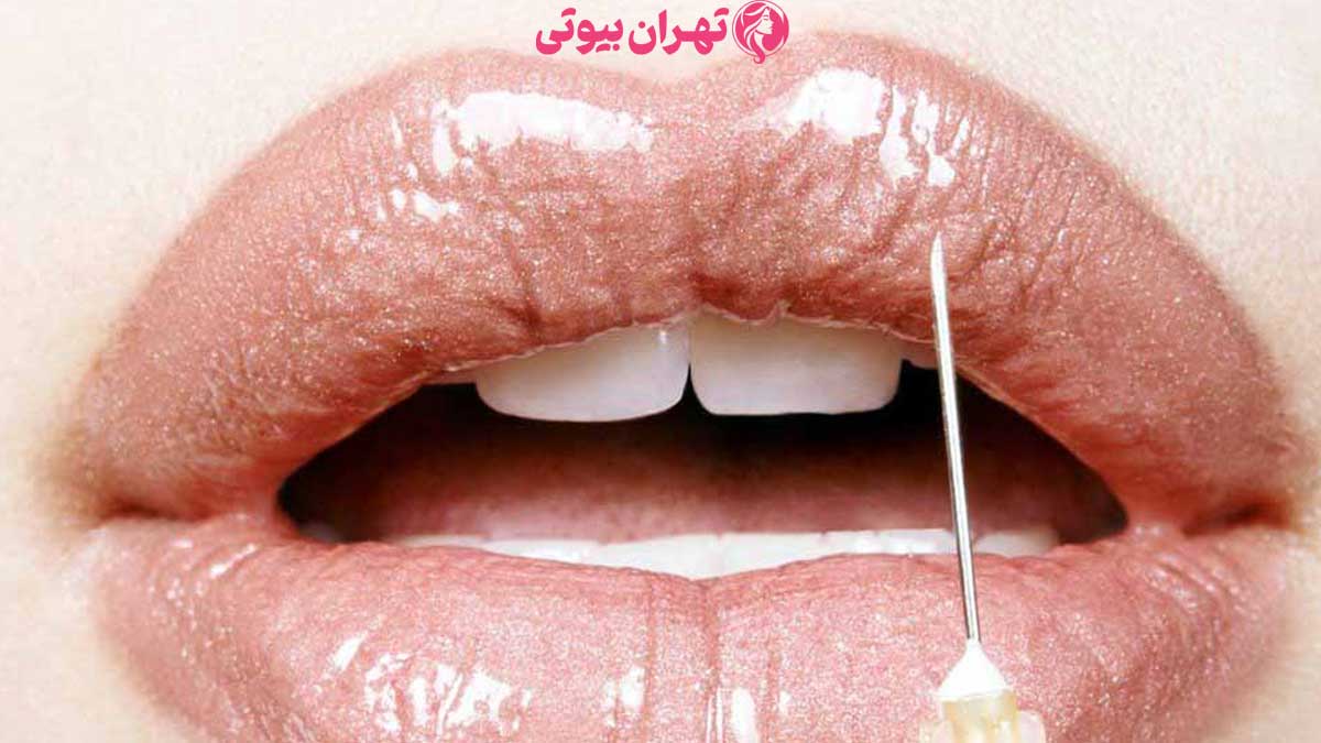 10 بهترین دکتر لیفت لب در تهران