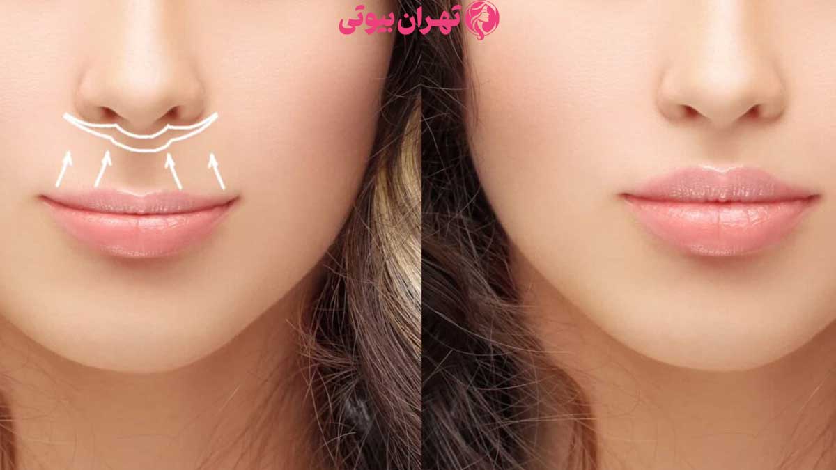 10 بهترین دکتر لیفت لب در تهران