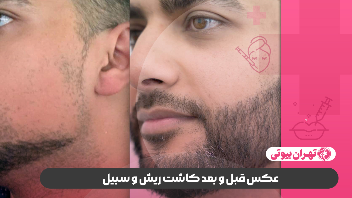 عکس قبل و بعد کاشت ریش و سبیل