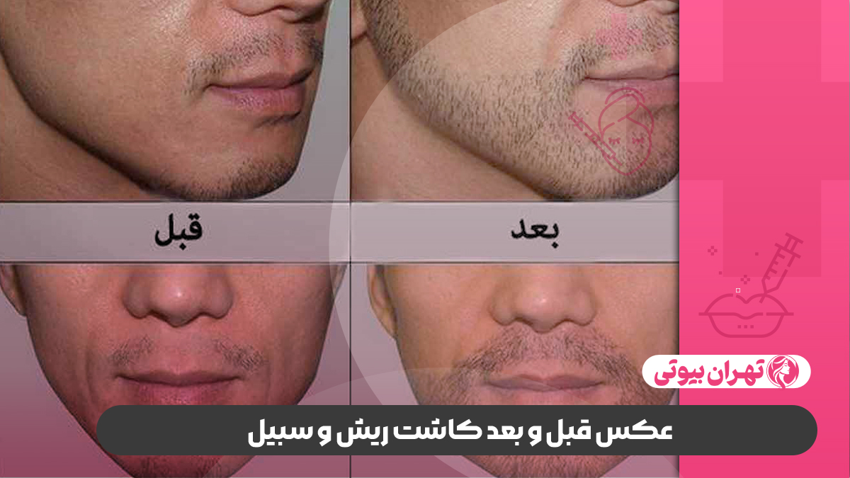 عکس قبل و بعد کاشت ریش و سبیل