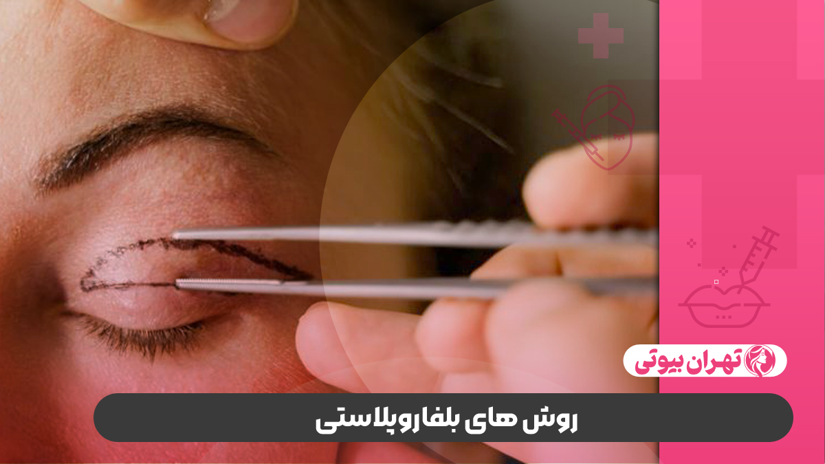 10 بهترین دکتر بلفاروپلاستی در تهران