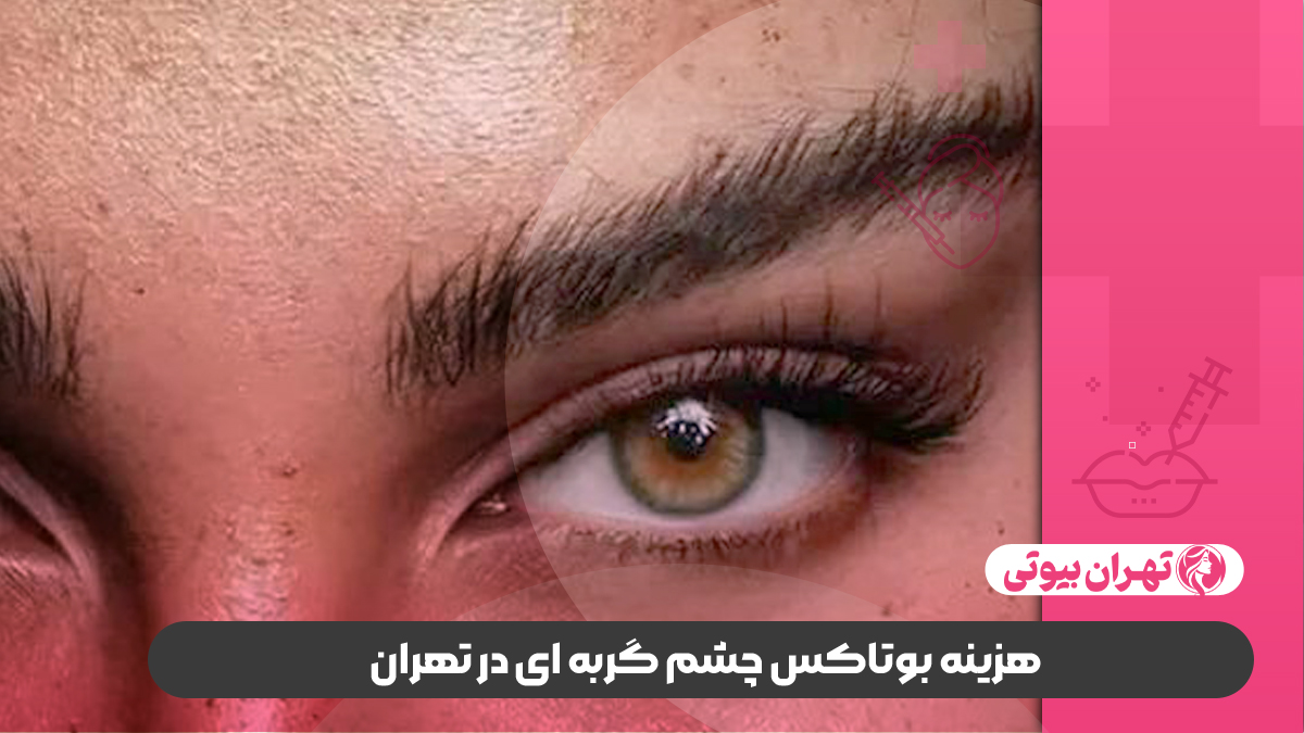 10 بهترین دکتر تزریق بوتاکس چشم گربه ای در تهران