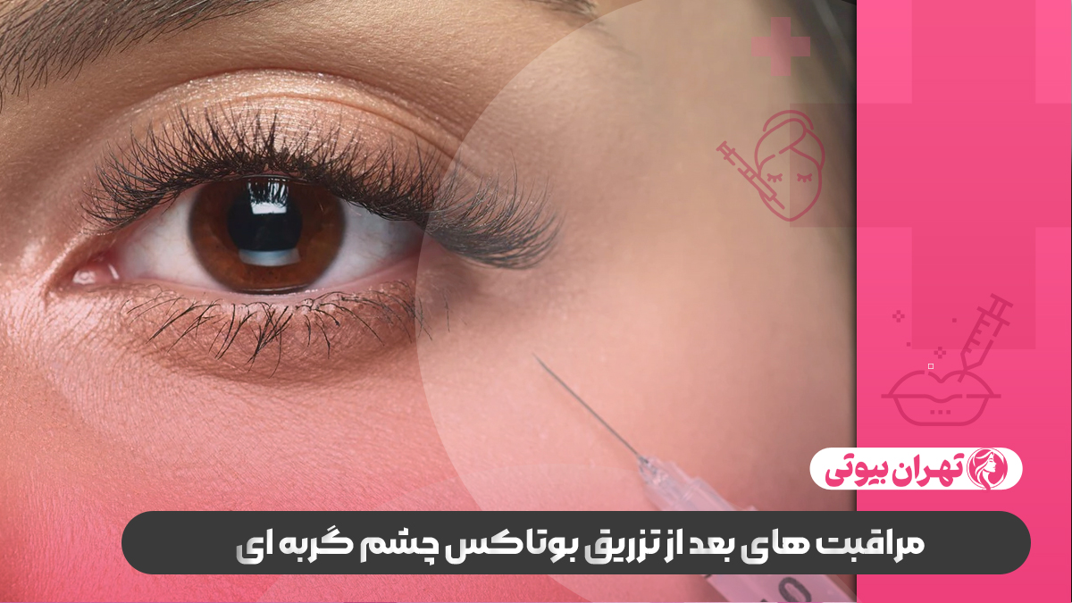 10 بهترین دکتر تزریق بوتاکس چشم گربه ای در تهران