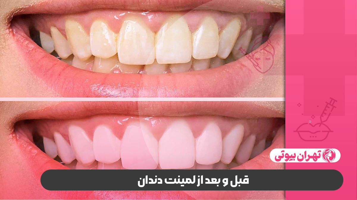 10 بهترین دکتر لمینت دندان در تهران