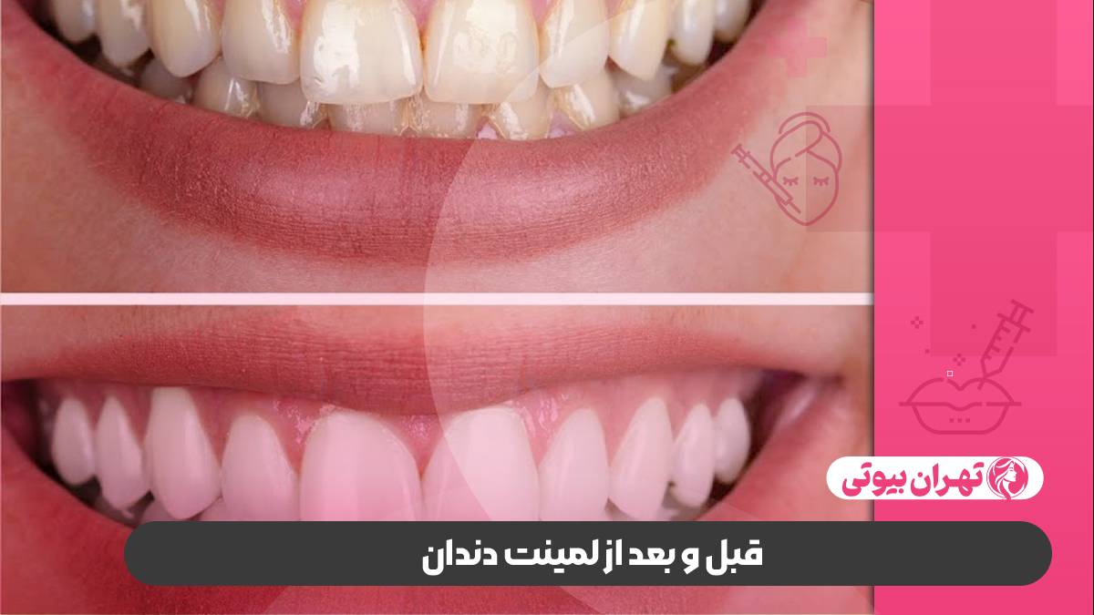 10 بهترین دکتر لمینت دندان در تهران