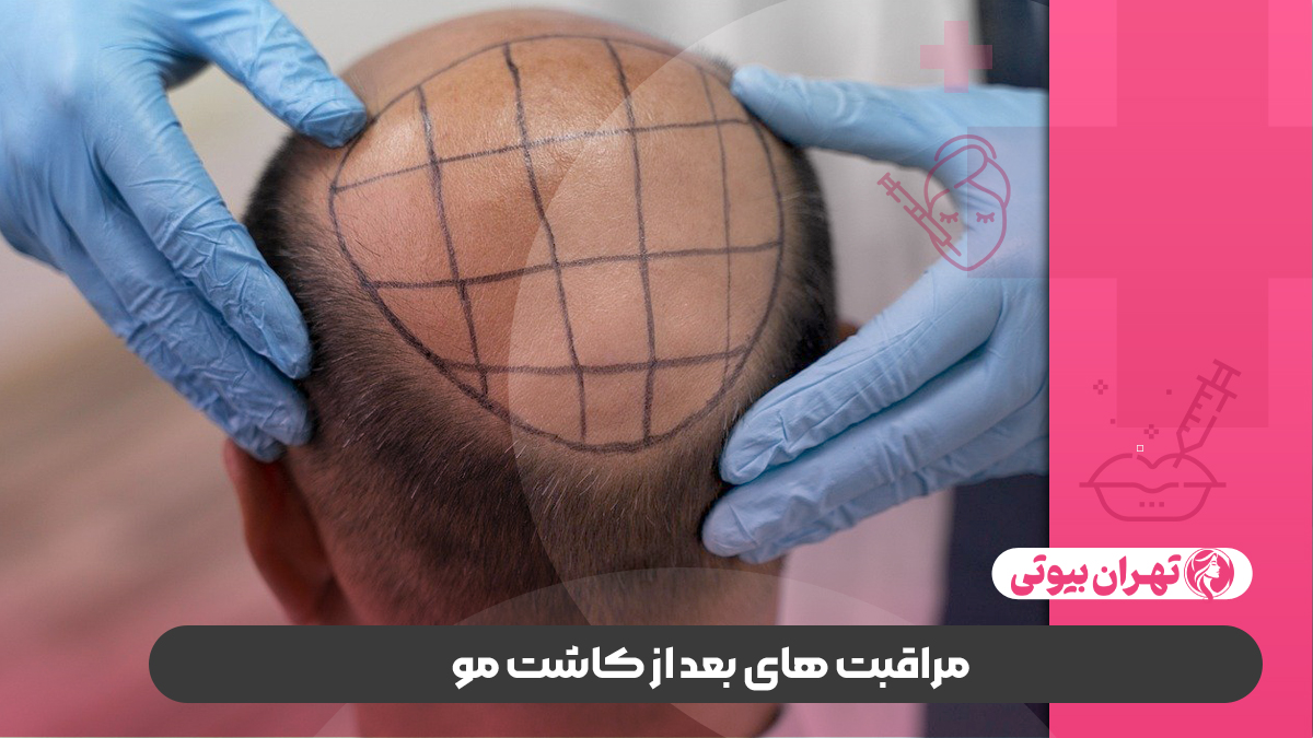 10 بهترین کلینیک کاشت مو در تهران