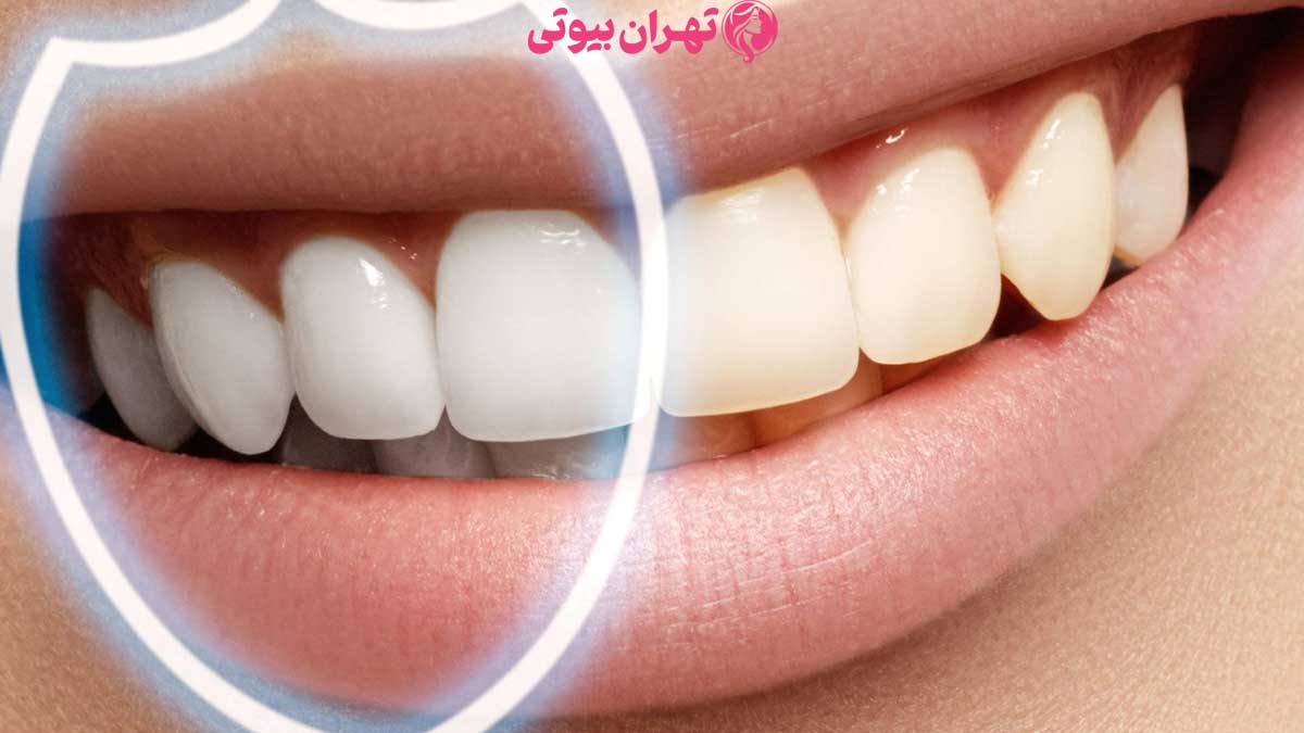 10 بهترین دکتر بلیچینگ دندان در تهران