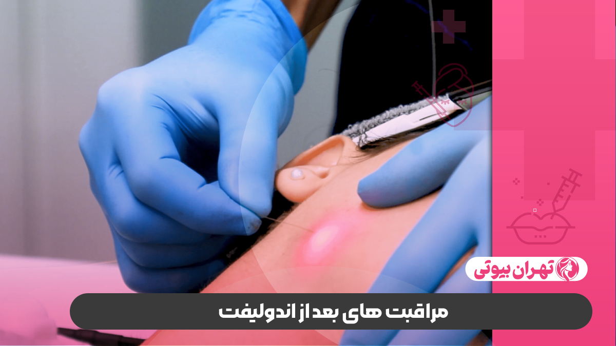 10 بهترین دکتر اندولیفت در تهران