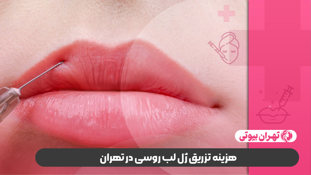 10 بهترین دکتر تزریق ژل لب روسی در تهران