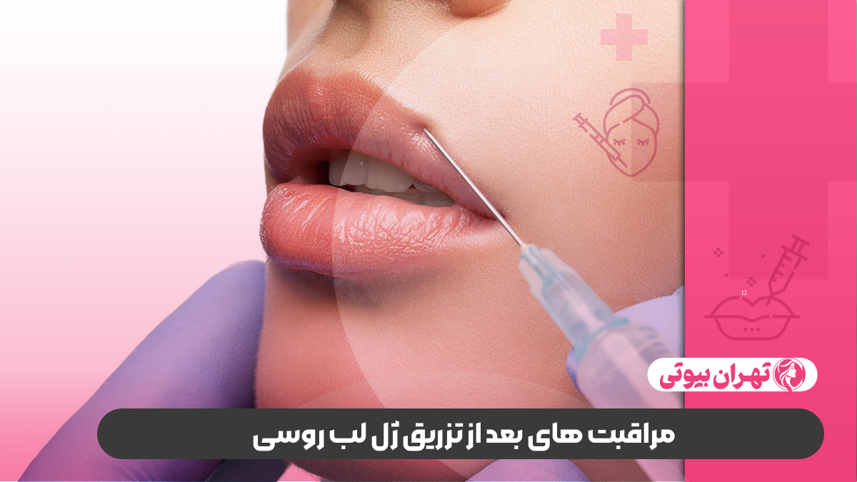 10 بهترین دکتر تزریق ژل لب روسی در تهران