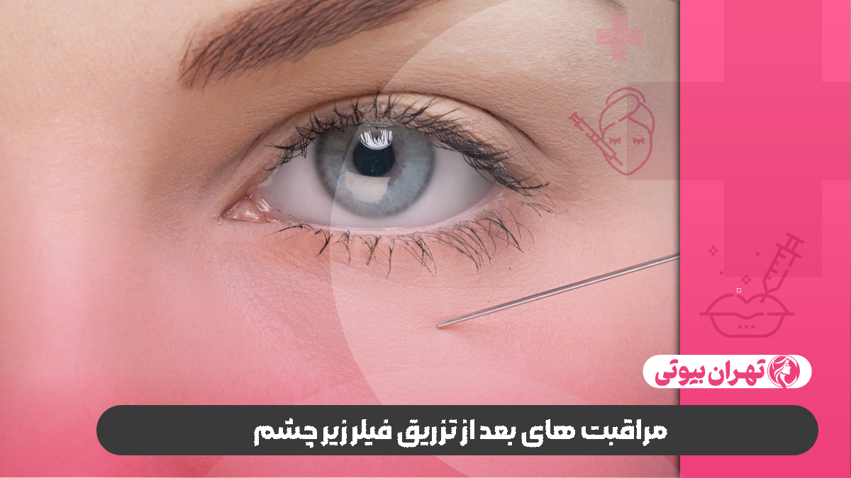 10 بهترین دکتر تزریق فیلر زیر چشم در تهران
