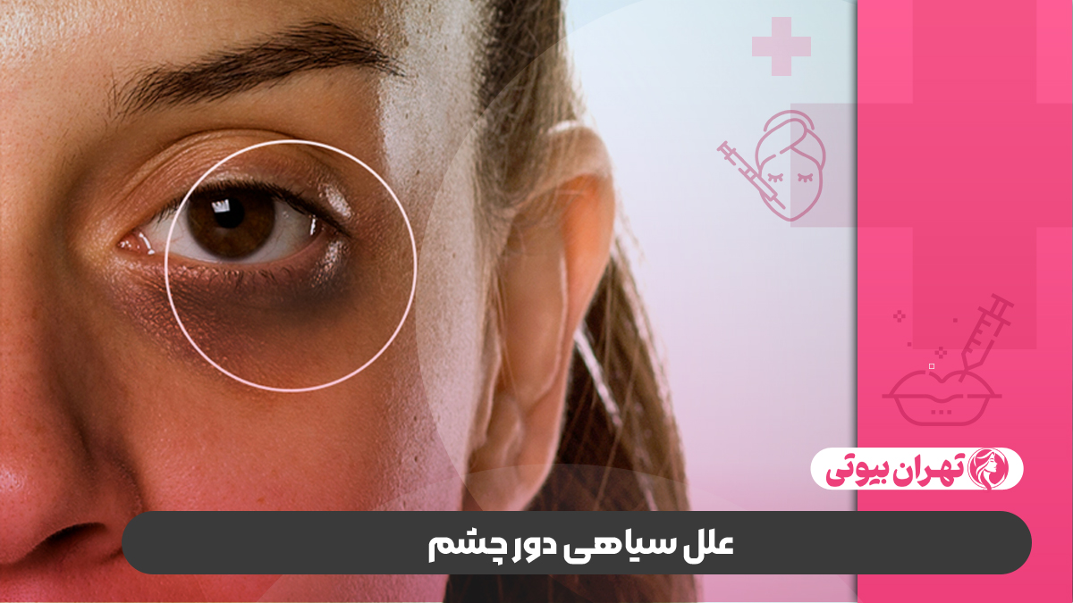 10 بهترین دکتر درمان سیاهی دور چشم در تهران