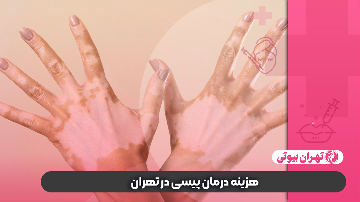 10 بهترین دکتر درمان قطعی پیسی در تهران (ویتیلیگو)