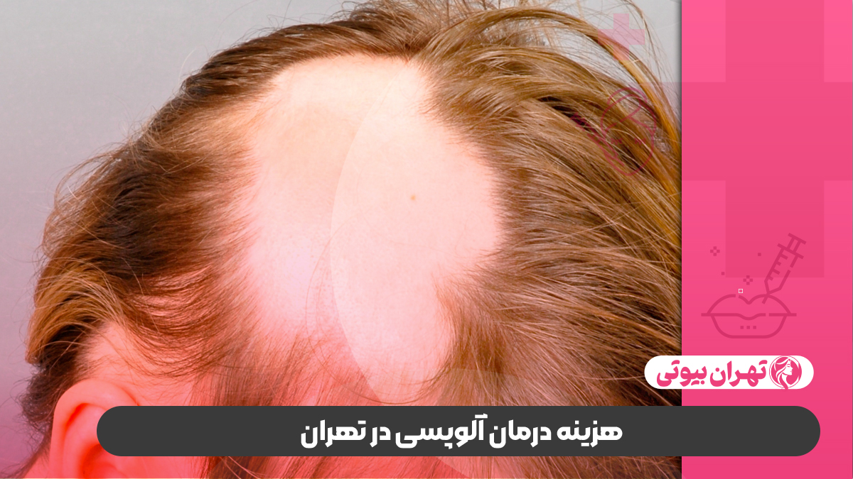 10 بهترین دکتر درمان آلوپسی در تهران