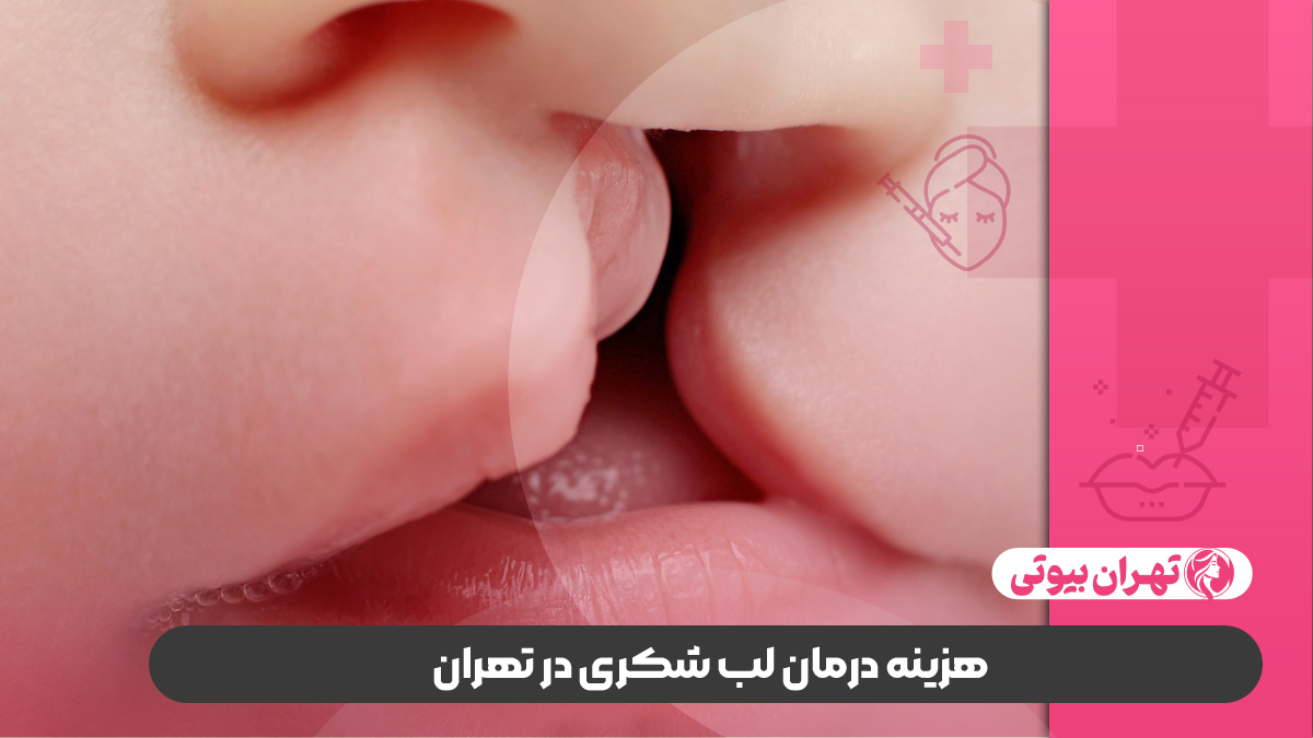 10 بهترین دکتر درمان لب شکری در تهران (شکاف کام و لب)