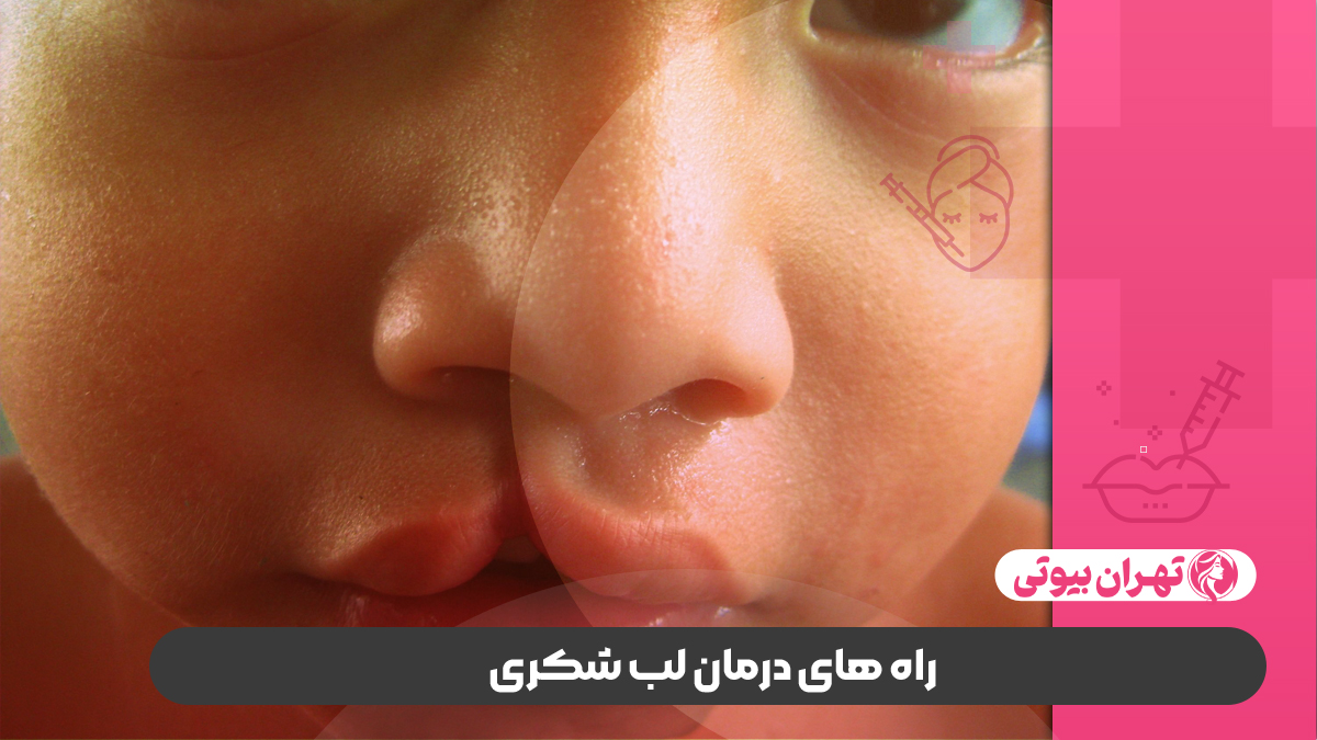 10 بهترین دکتر درمان لب شکری در تهران (شکاف کام و لب)