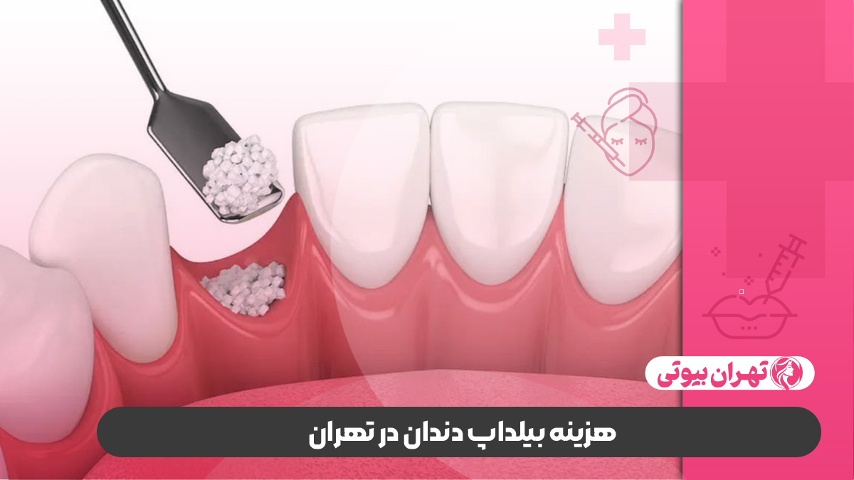 10 بهترین دکتر بیلداپ دندان در تهران