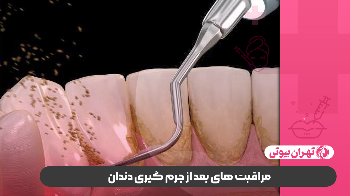 10 بهترین دکتر جرم گیری دندان در تهران