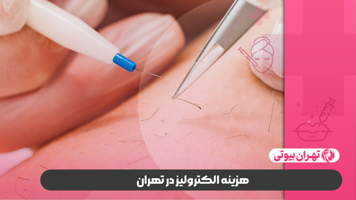 10 بهترین مرکز الکترولیز در تهران