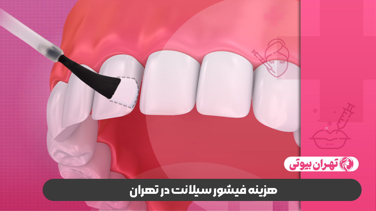 10 بهترین متخصص فیشور سیلانت در تهران