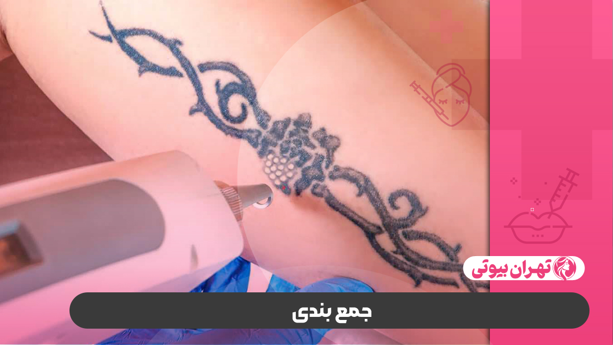 10 بهترین مرکز پاک کردن تاتو در تهران