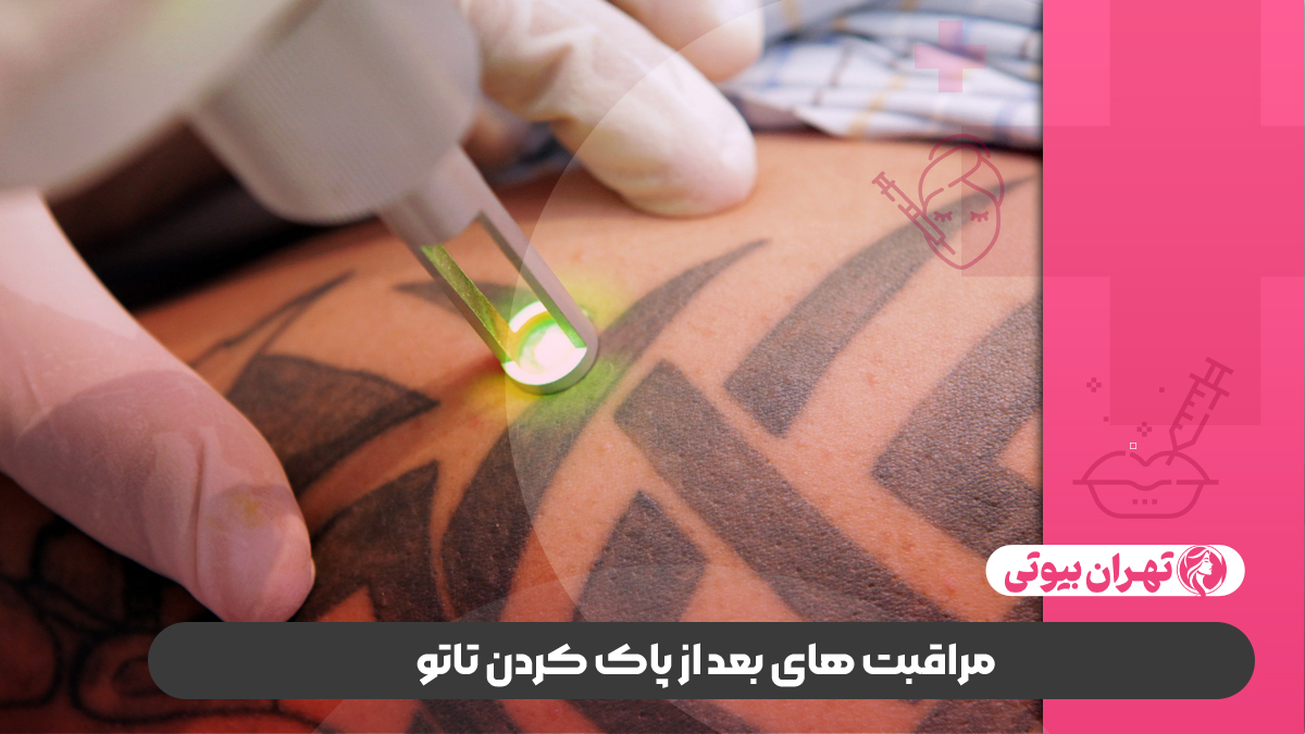 10 بهترین مرکز پاک کردن تاتو در تهران