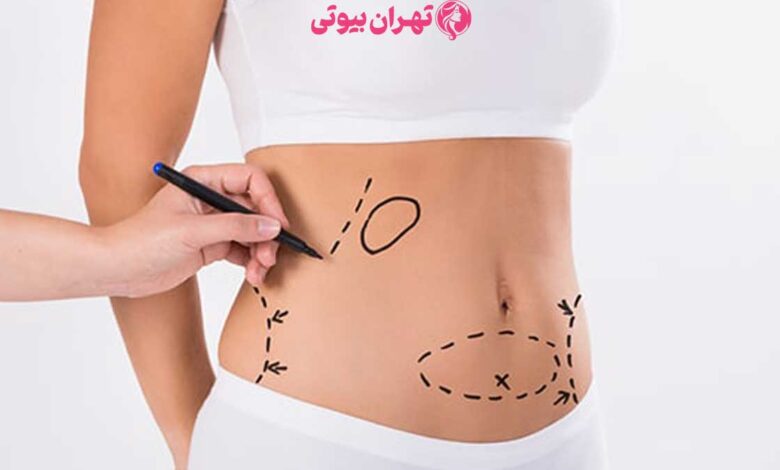 10 بهترین جراح لیپوماتیک در کرج
