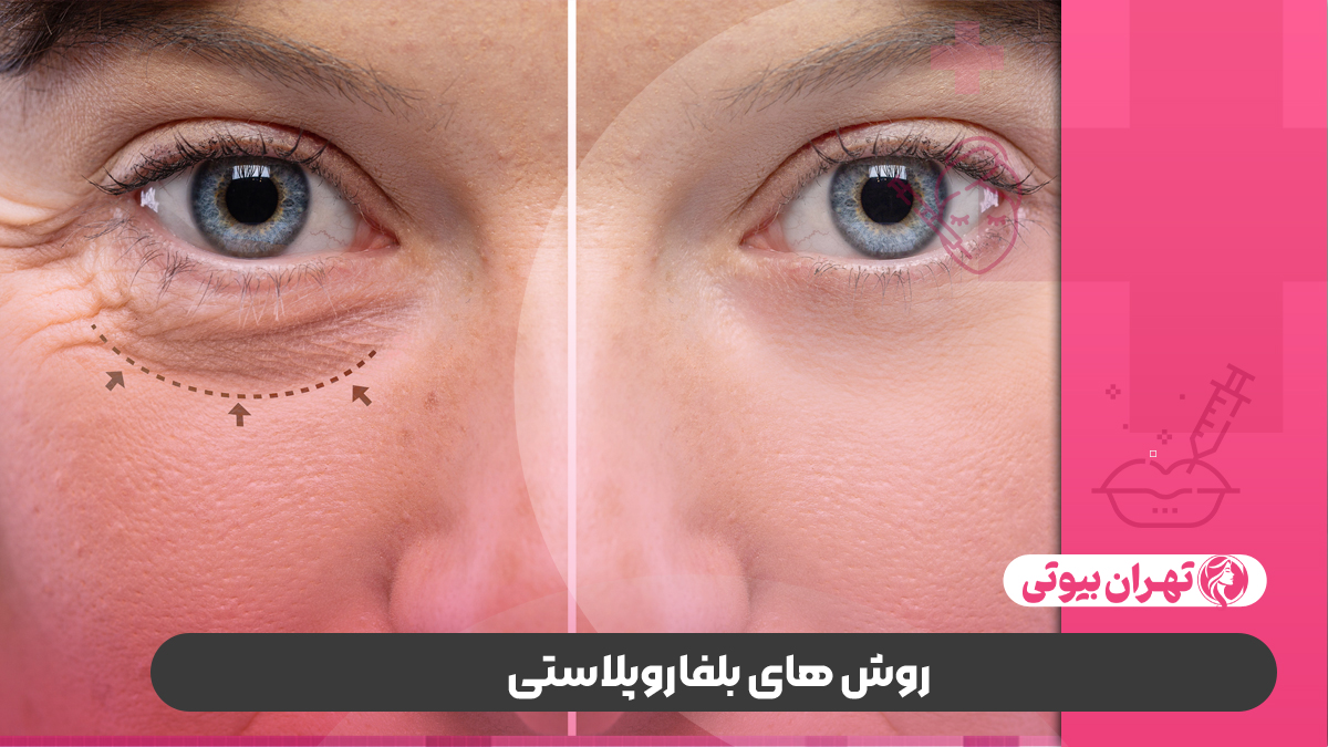 10 بهترین دکتر فوق تخصص بلفاروپلاستی در کرج