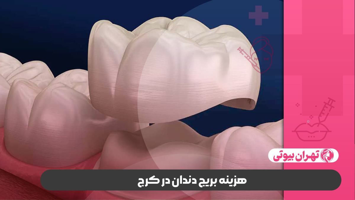 10 بهترین دکتر بریج دندان در کرج