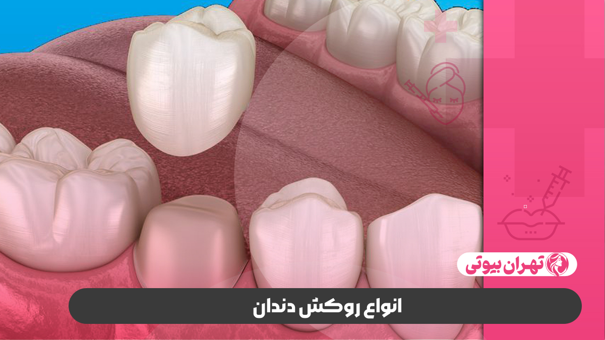 10 بهترین دکتر روکش دندان در کرج