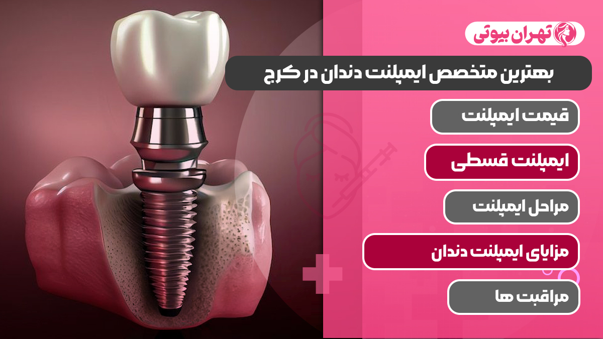 10 بهترین متخصص ایمپلنت دندان در کرج