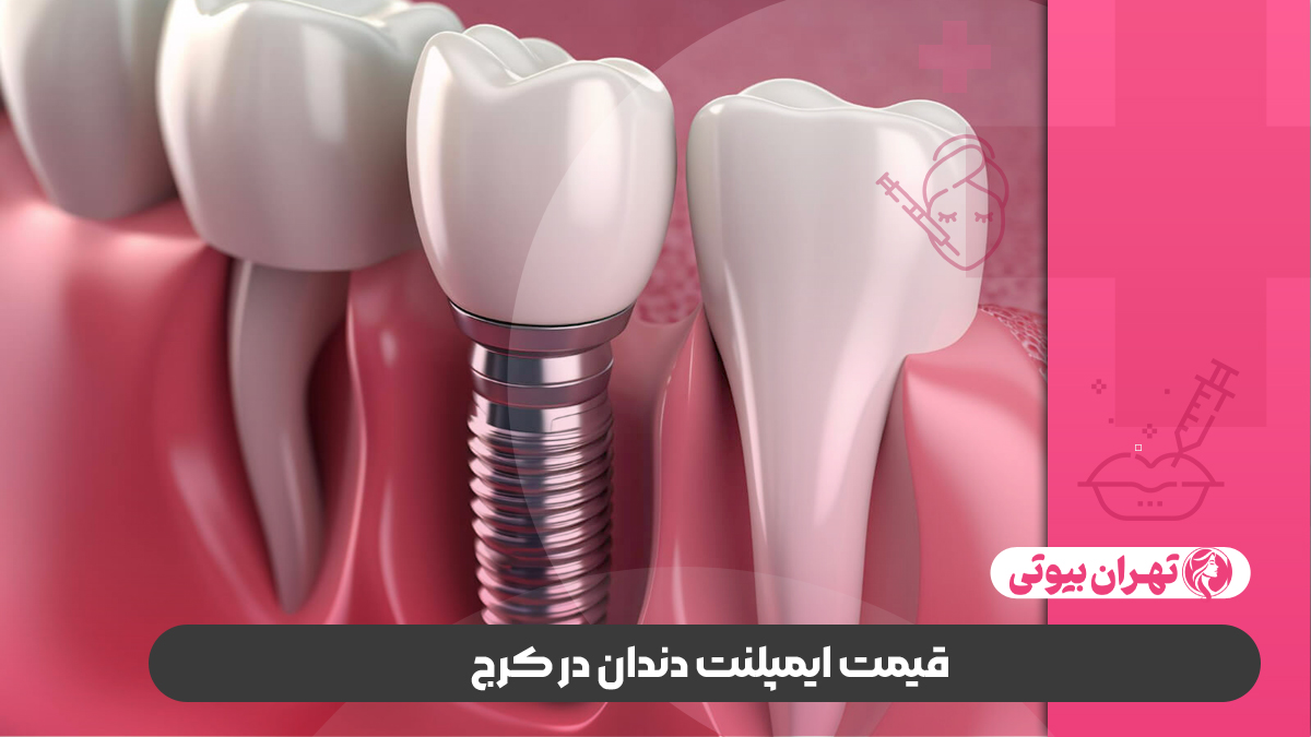10 بهترین متخصص ایمپلنت دندان در کرج