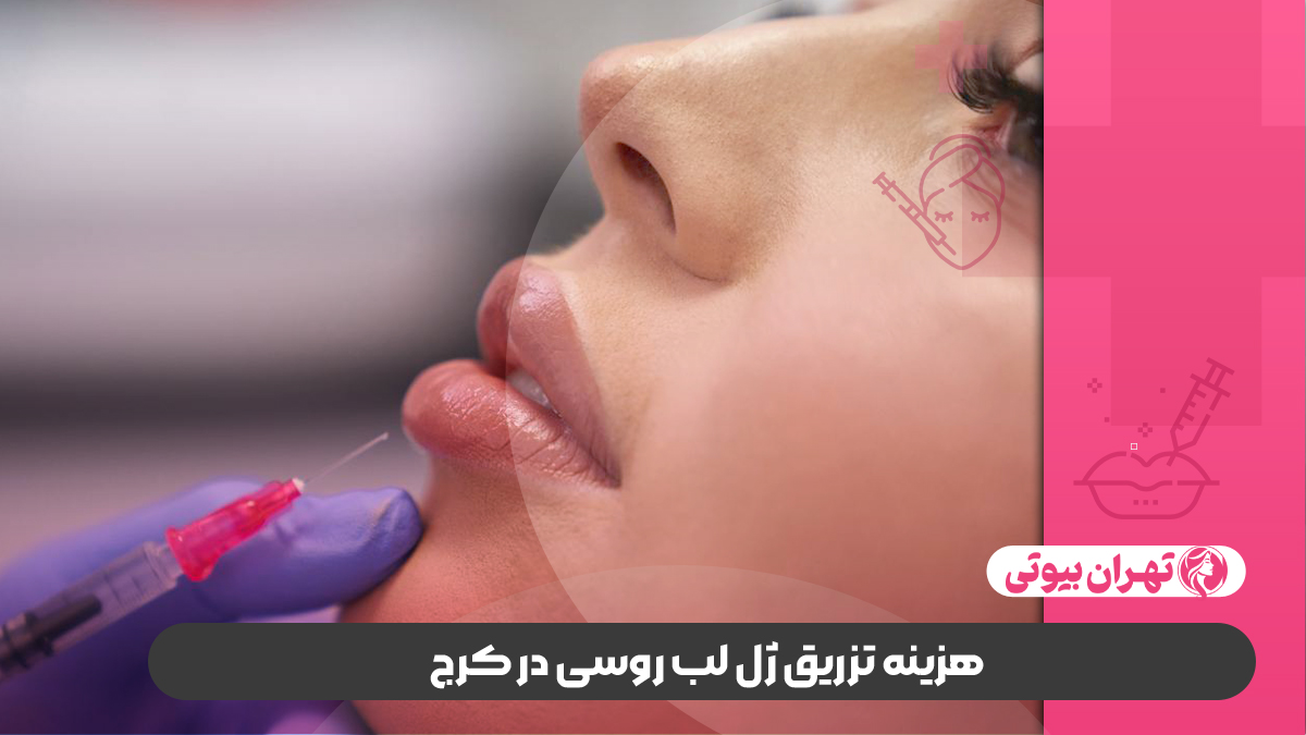 10 بهترین دکتر تزریق ژل لب روسی در کرج