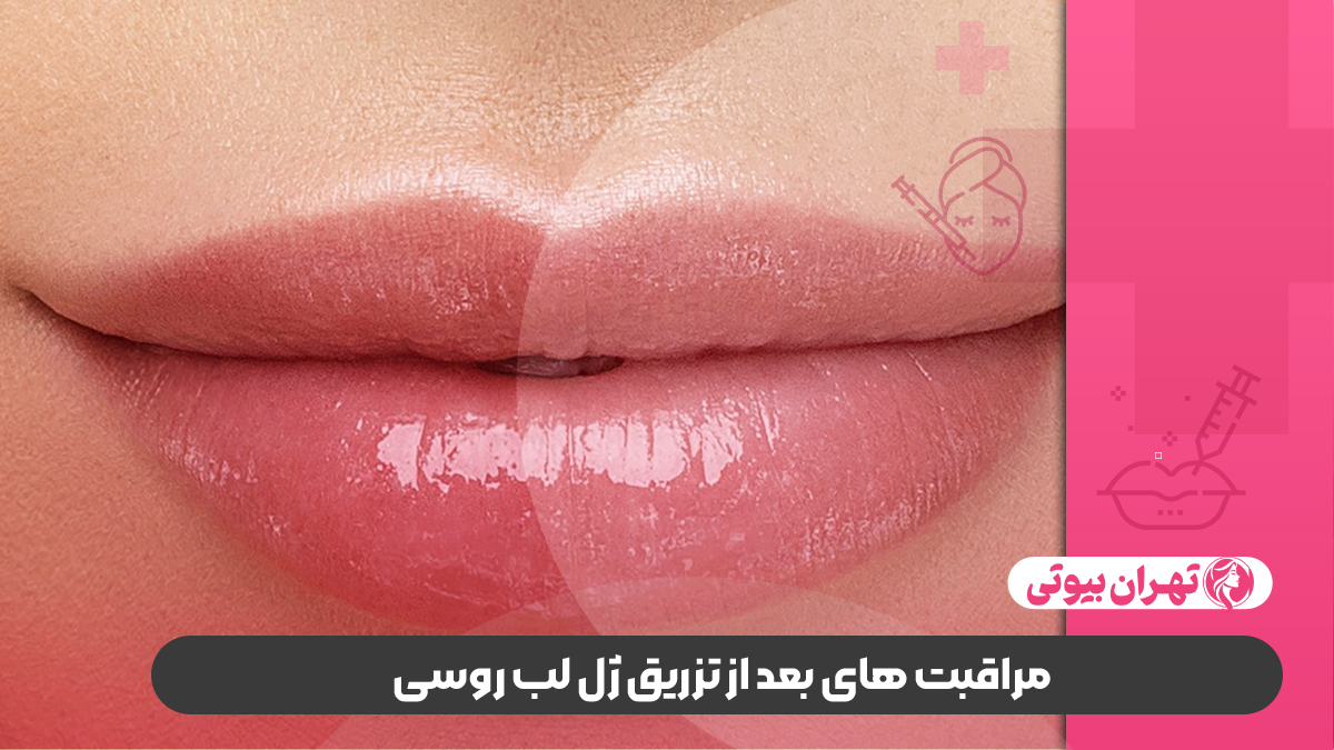 10 بهترین دکتر تزریق ژل لب روسی در کرج