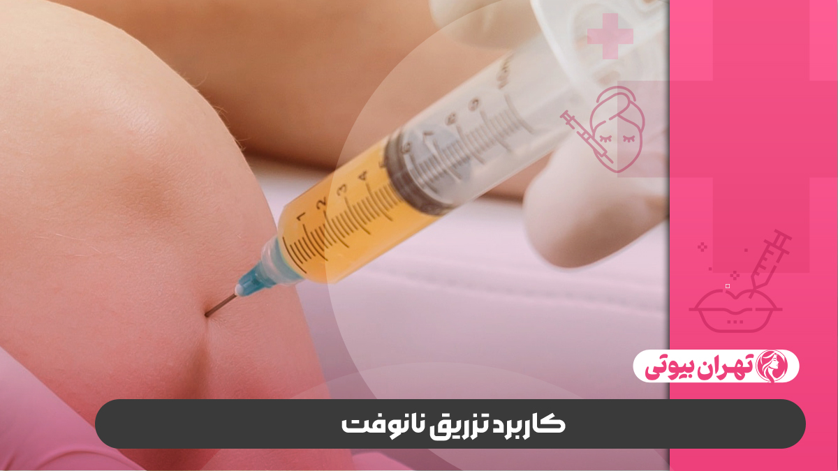 10 بهترین دکتر تزریق نانوفت در کرج