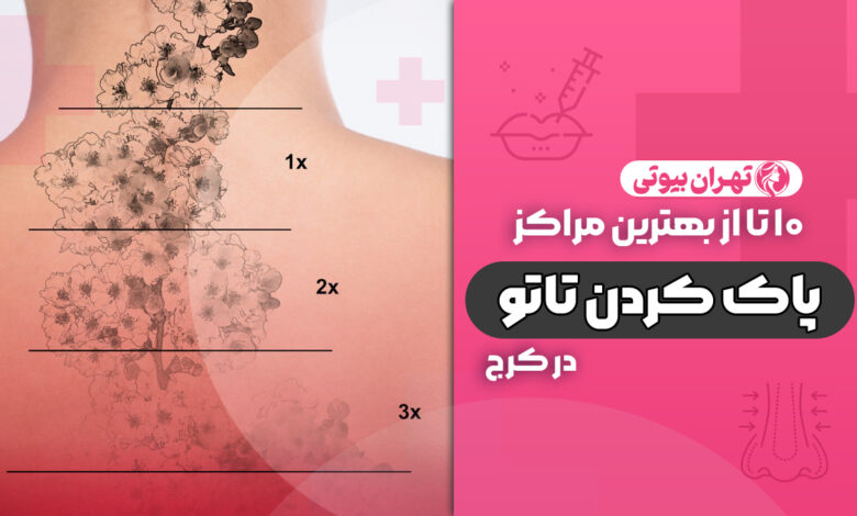 10 بهترین مرکز پاک کردن تاتو در کرج