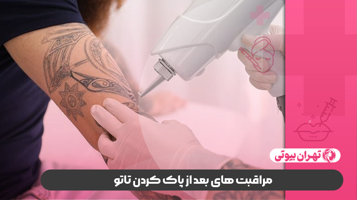10 بهترین مرکز پاک کردن تاتو در کرج
