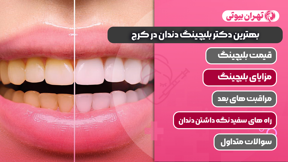 10 بهترین دکتر بلیچینگ دندان در کرج