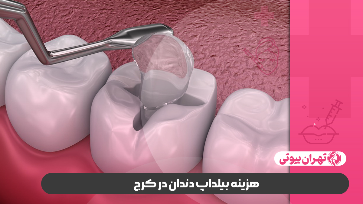 10 بهترین دکتر بیلداپ دندان در کرج