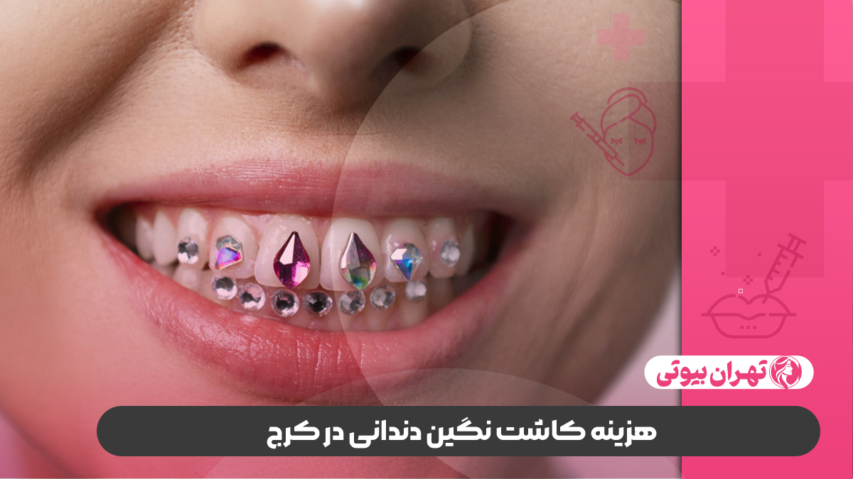 10 بهترین دکتر کاشت نگین دندانی در کرج