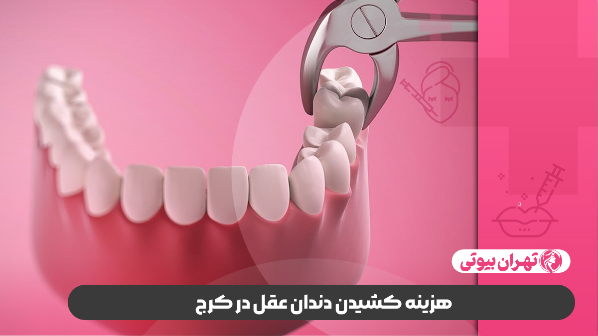 10 بهترین دکتر کشیدن دندان عقل در کرج
