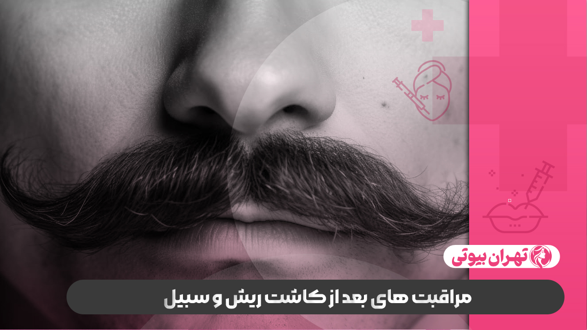 10 بهترین کلینیک کاشت ریش و سبیل در کرج